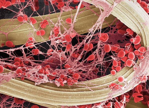 1-blood-clot-on-plaster-sem-steve-gschmeissner