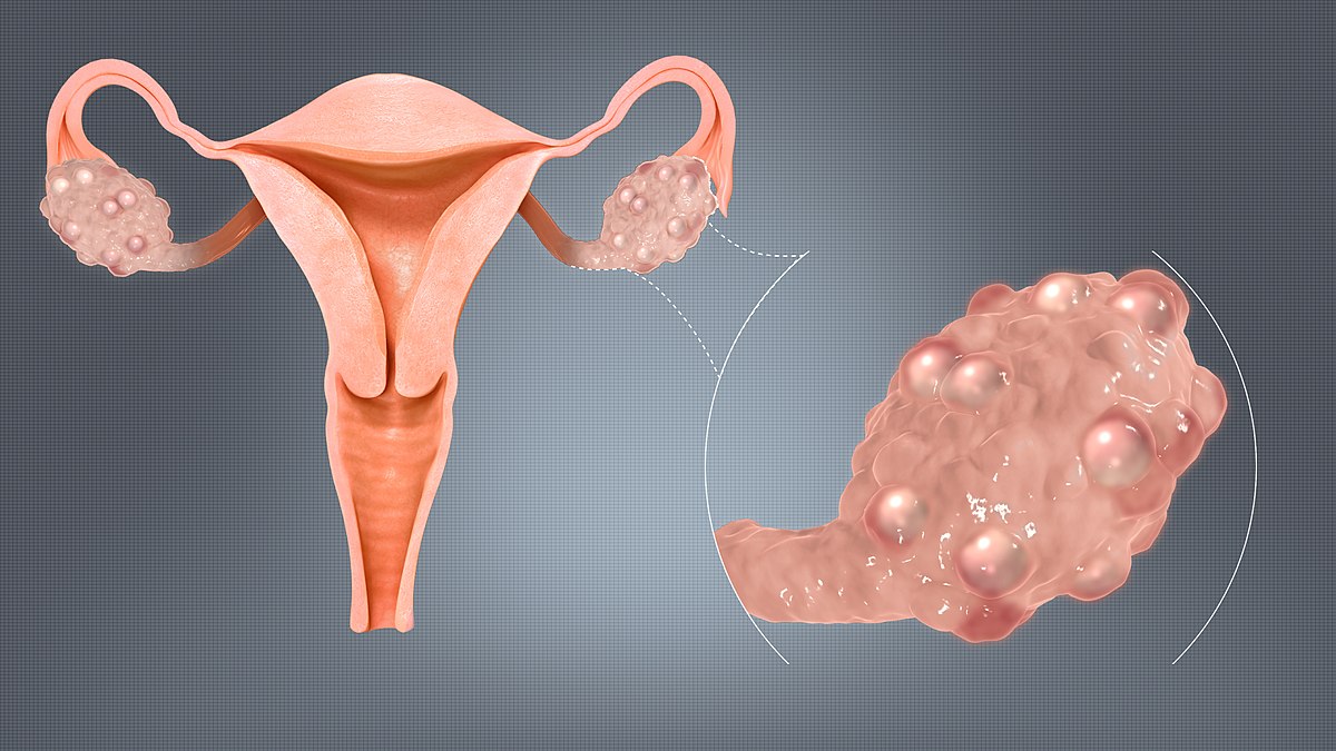 1200px-Polycystic_Ovaries