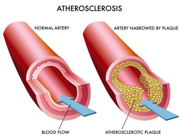 Atherosclerosis